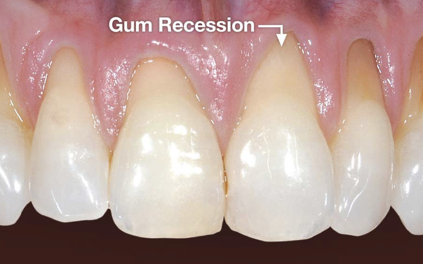 What Is Gum Recession