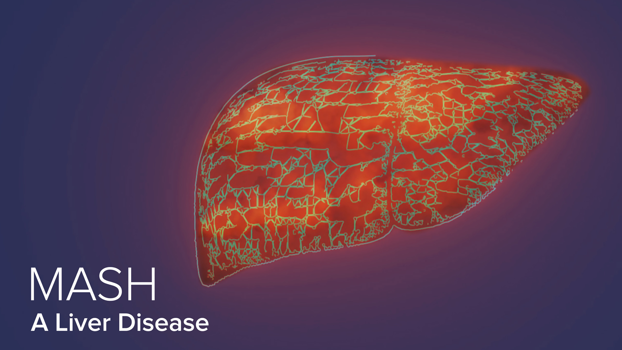 What Is Mash Liver Disease