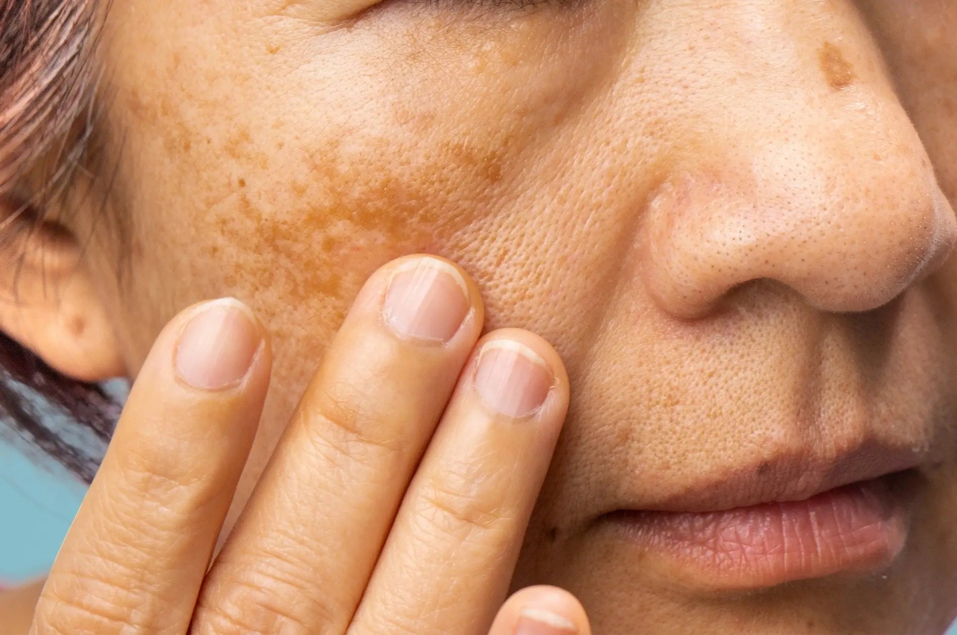 What Is Melasma On Face