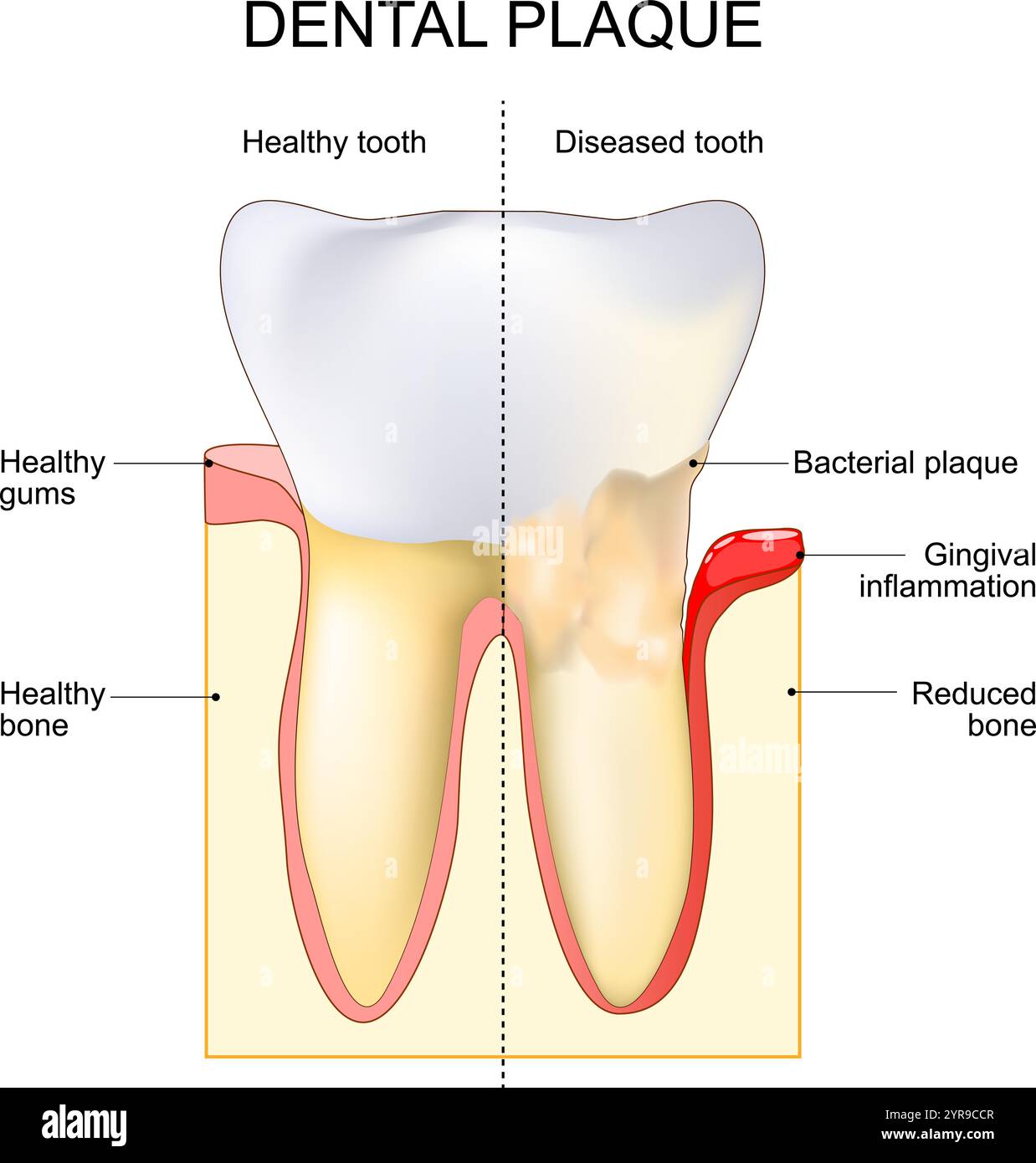 What Is Plaque On Teeth