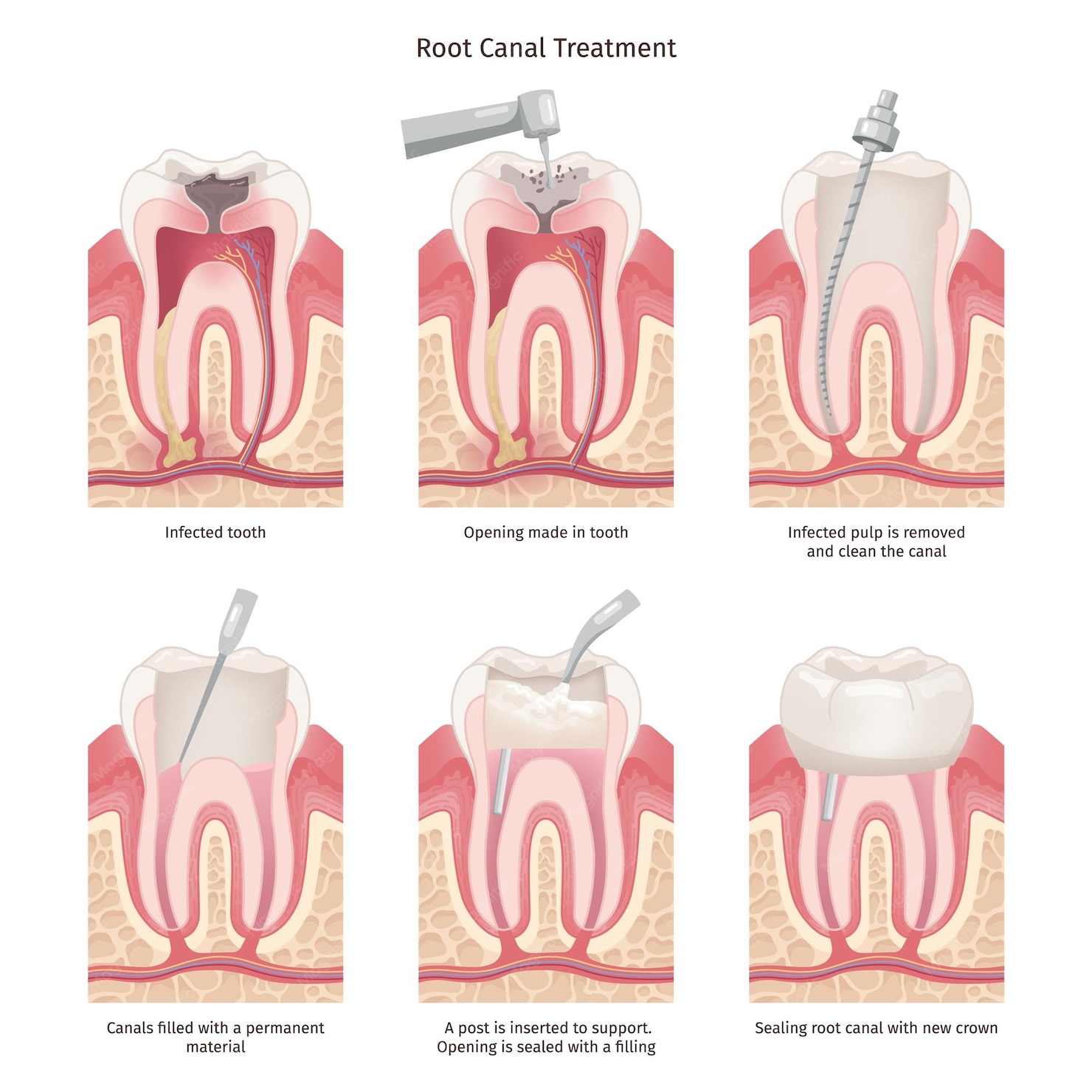 What Is Root Filling