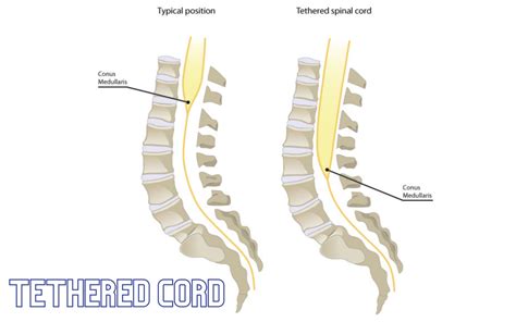 What Is Tethered Cord Syndrome