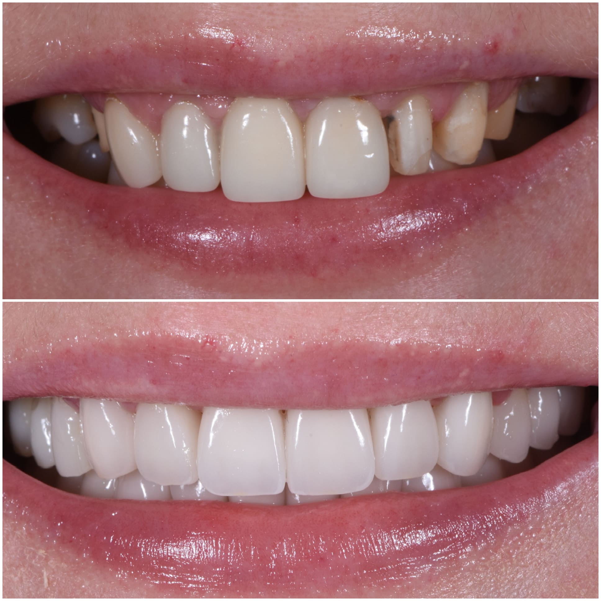 What Is Tooth Bonding