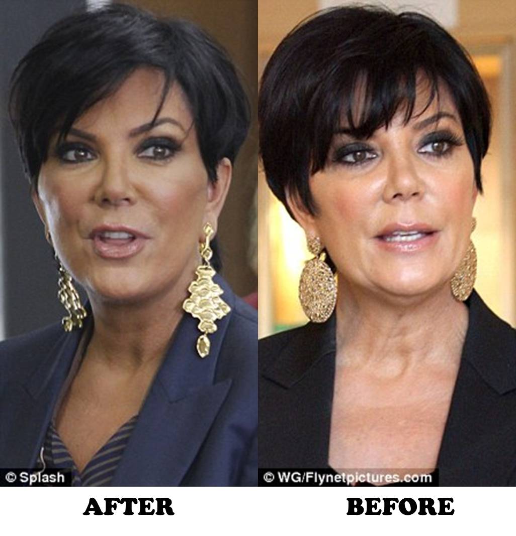 What Surgery Did Kris Jenner Have On Her Face