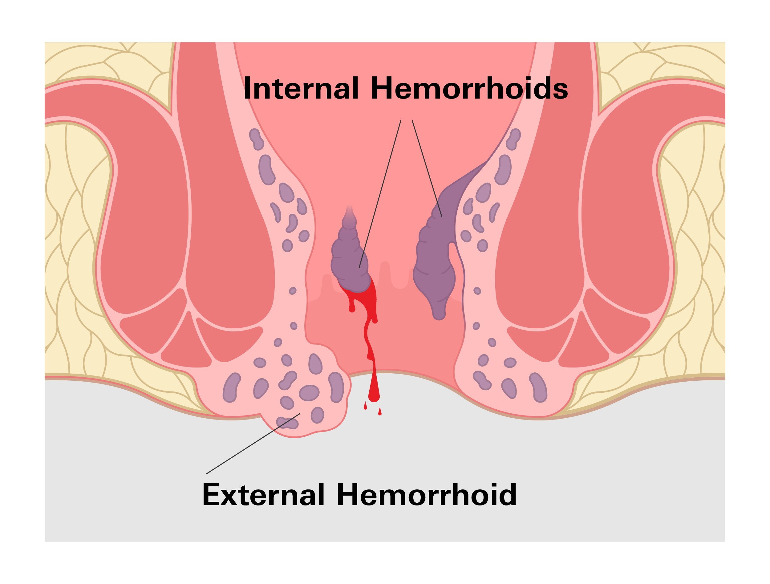 When Do Hemorrhoids Happen