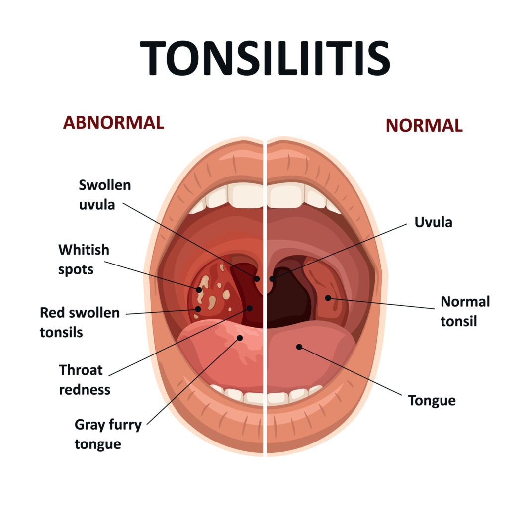 Where Is Tonsillitis Located