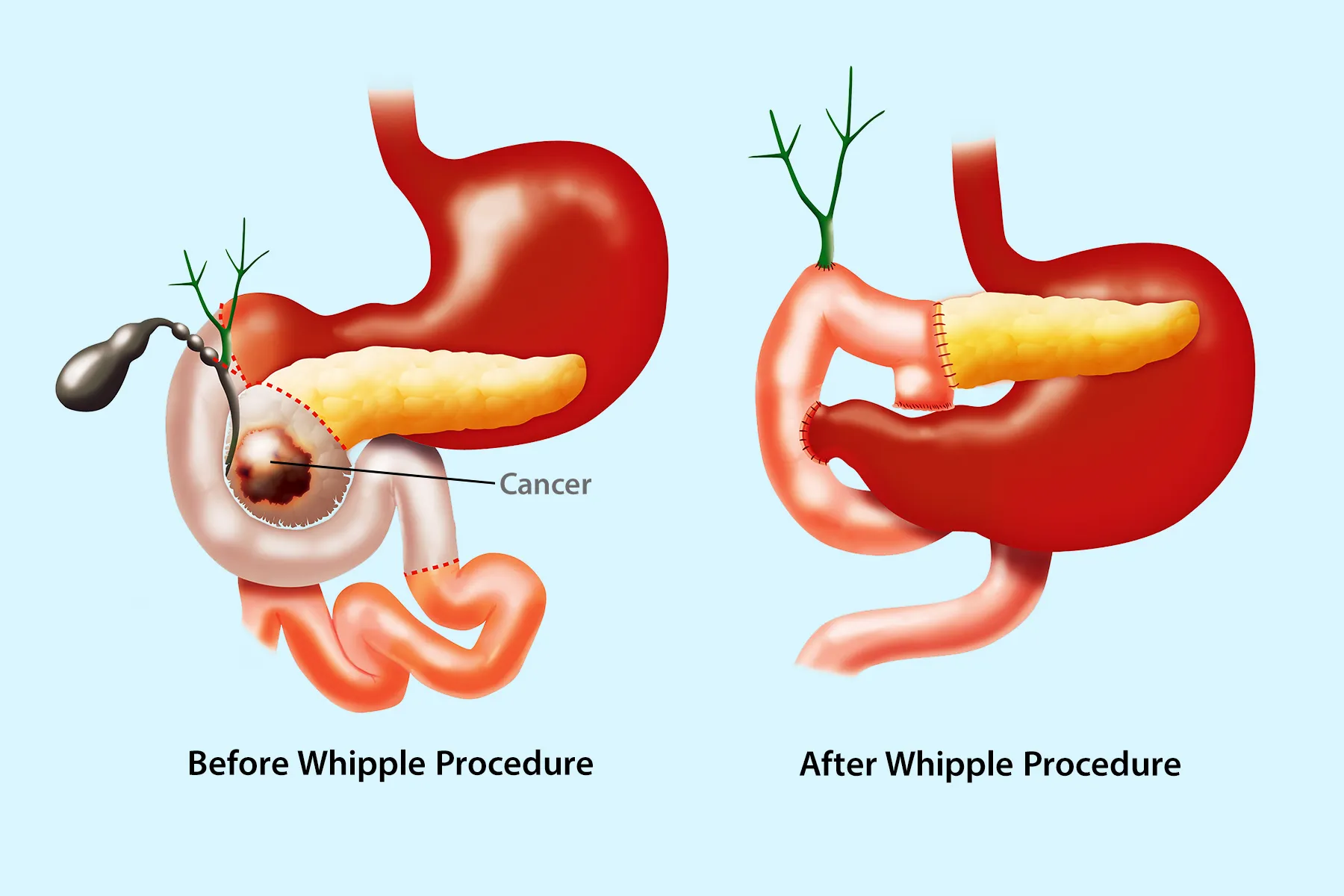 Whipple Procedure Survival Rate