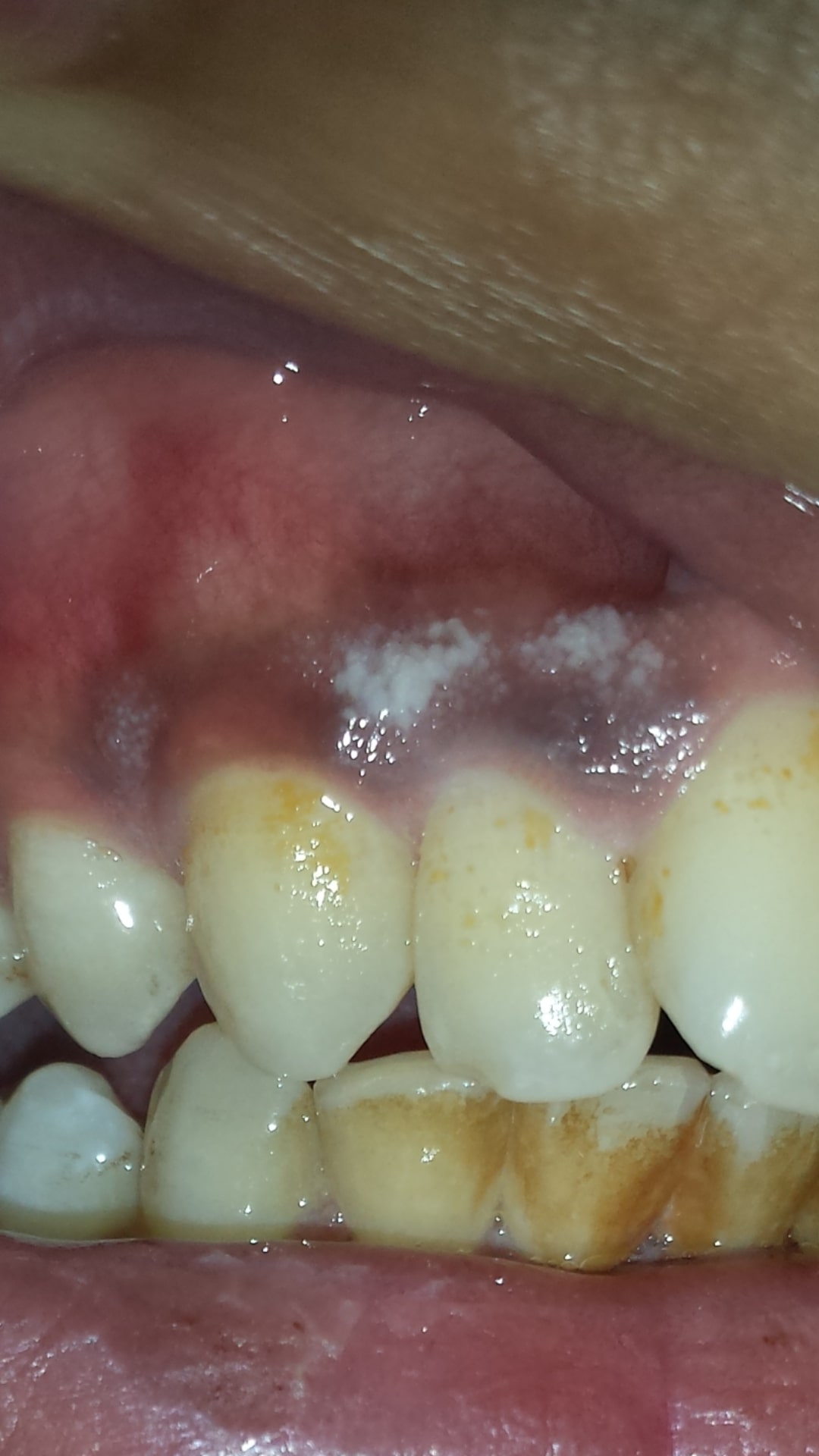 White Marks On Gums Pain