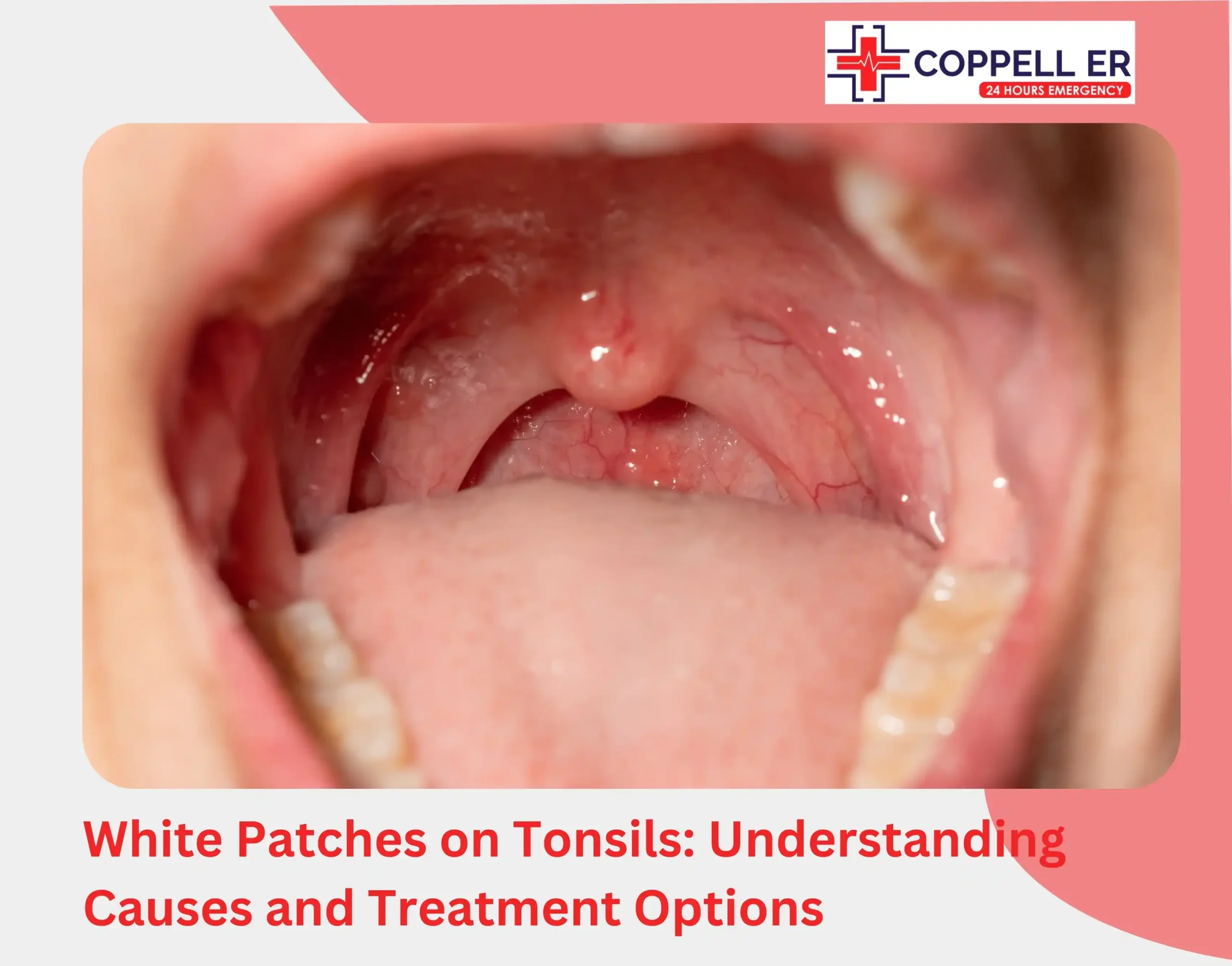 White Patches On Tonsils