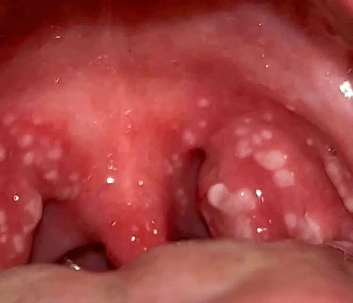 White Pimple In Throat