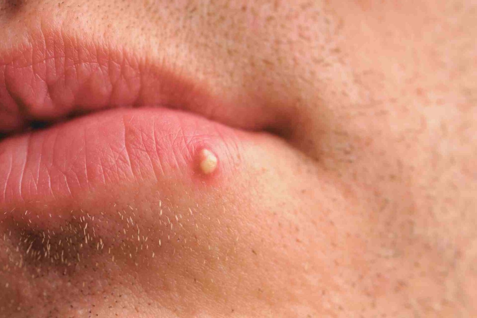 White Pimple On Lip