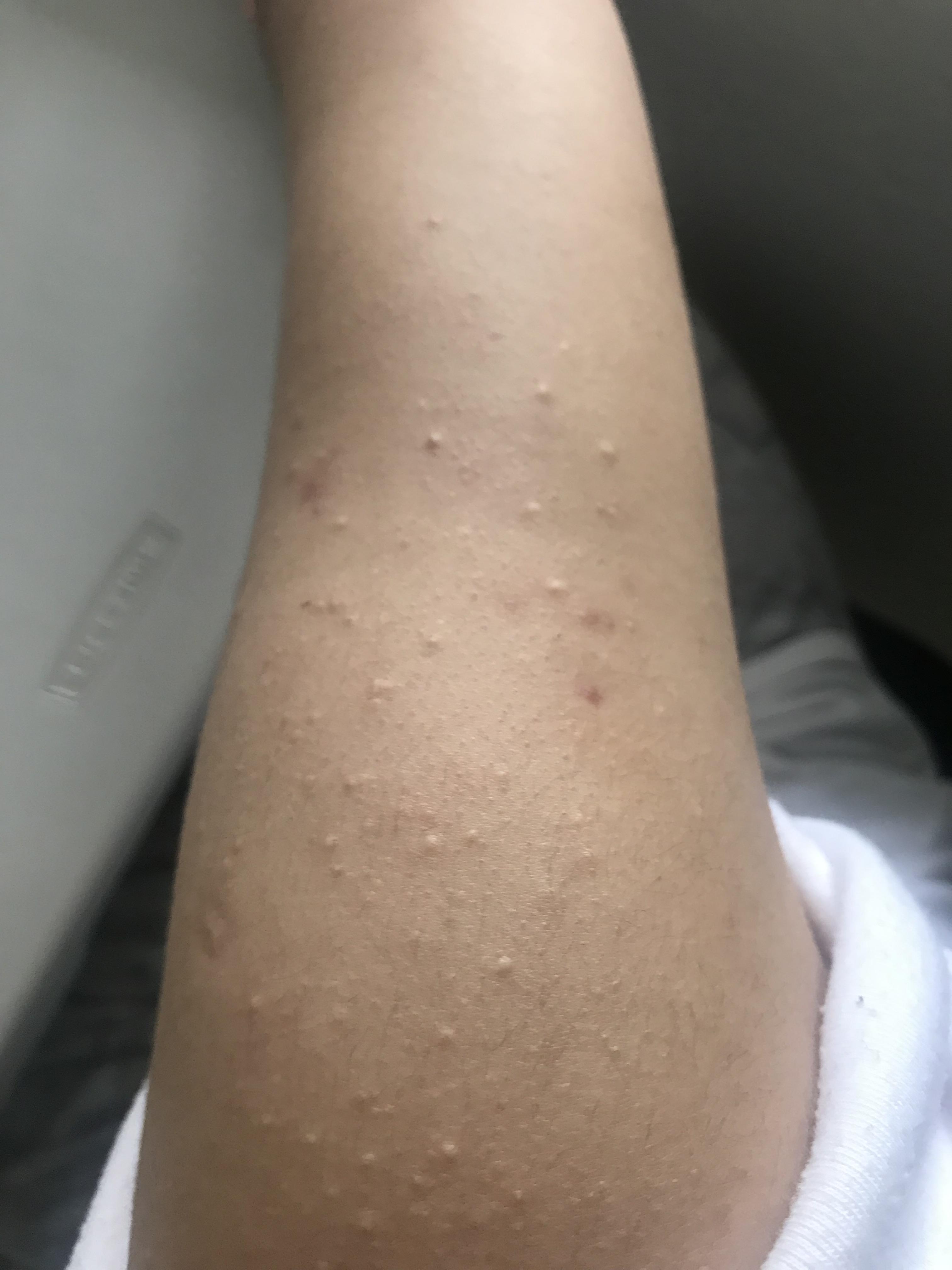 White Pimples On Arms
