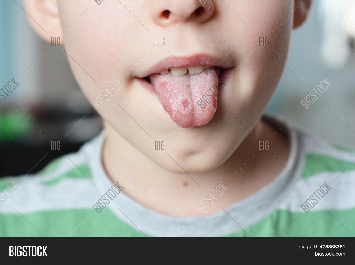 White Spots On Tongue
