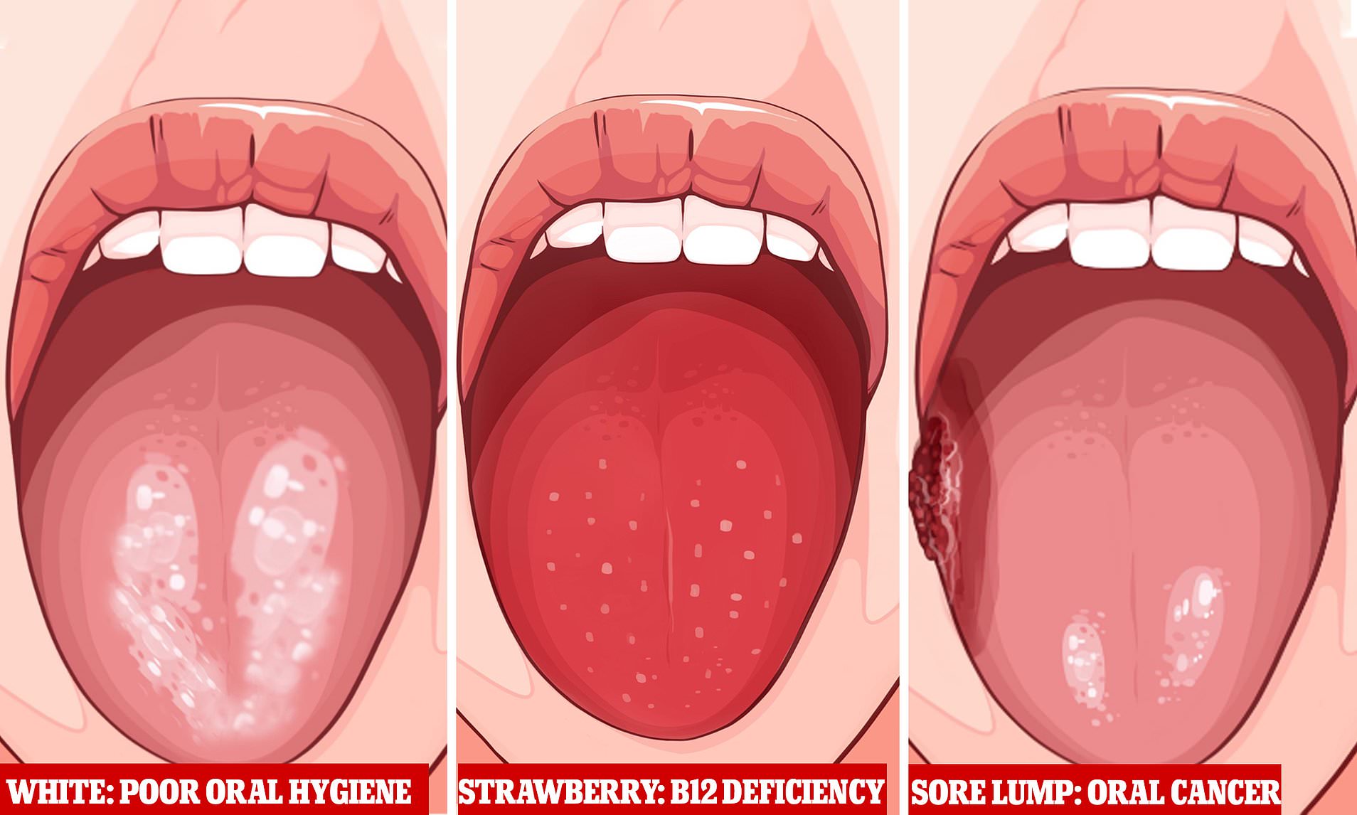 White Tongue With White Spots