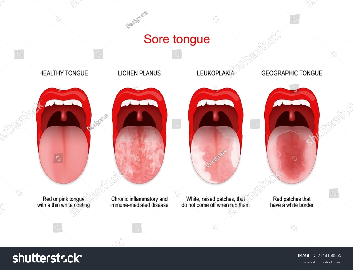 Whitish Tongue With Red Dots