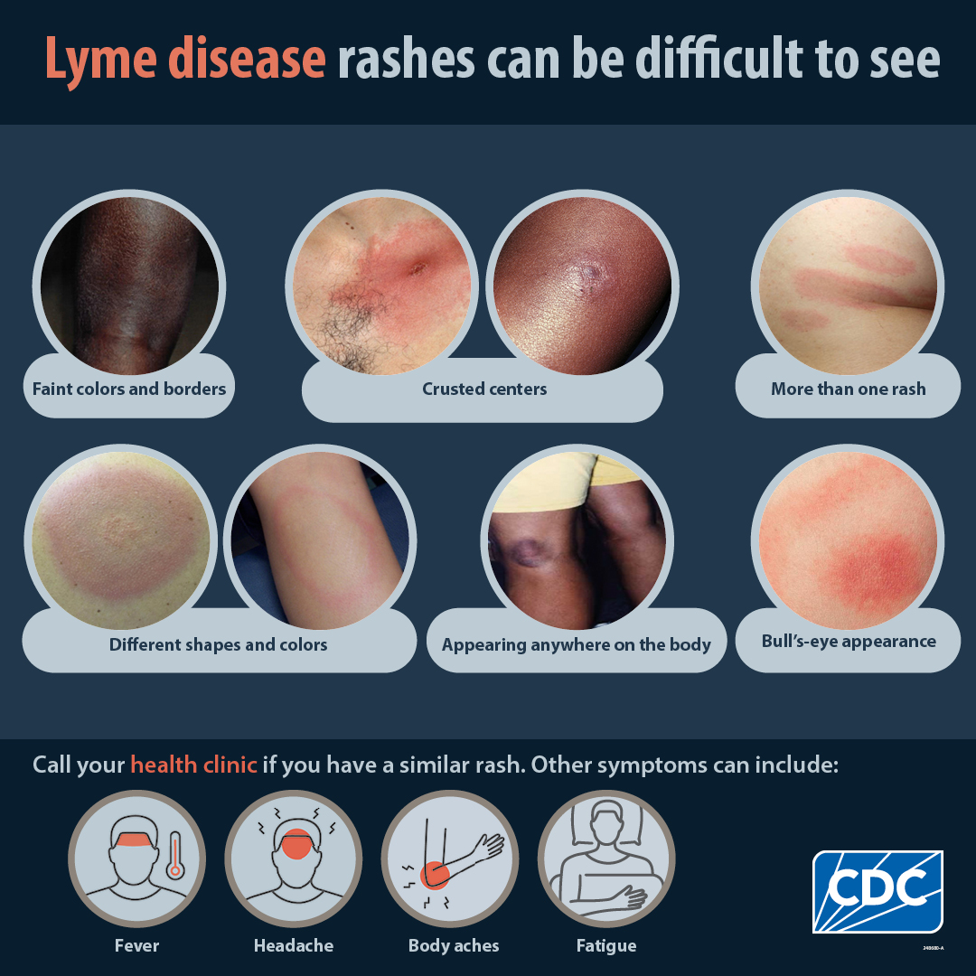 Who Discovered Lyme Disease