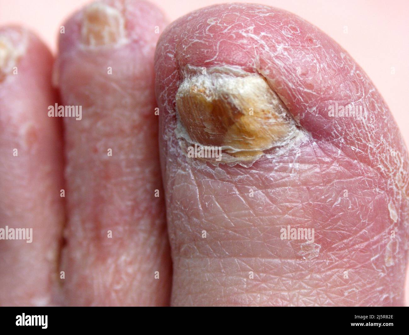 Why Are My Toenails Yellow