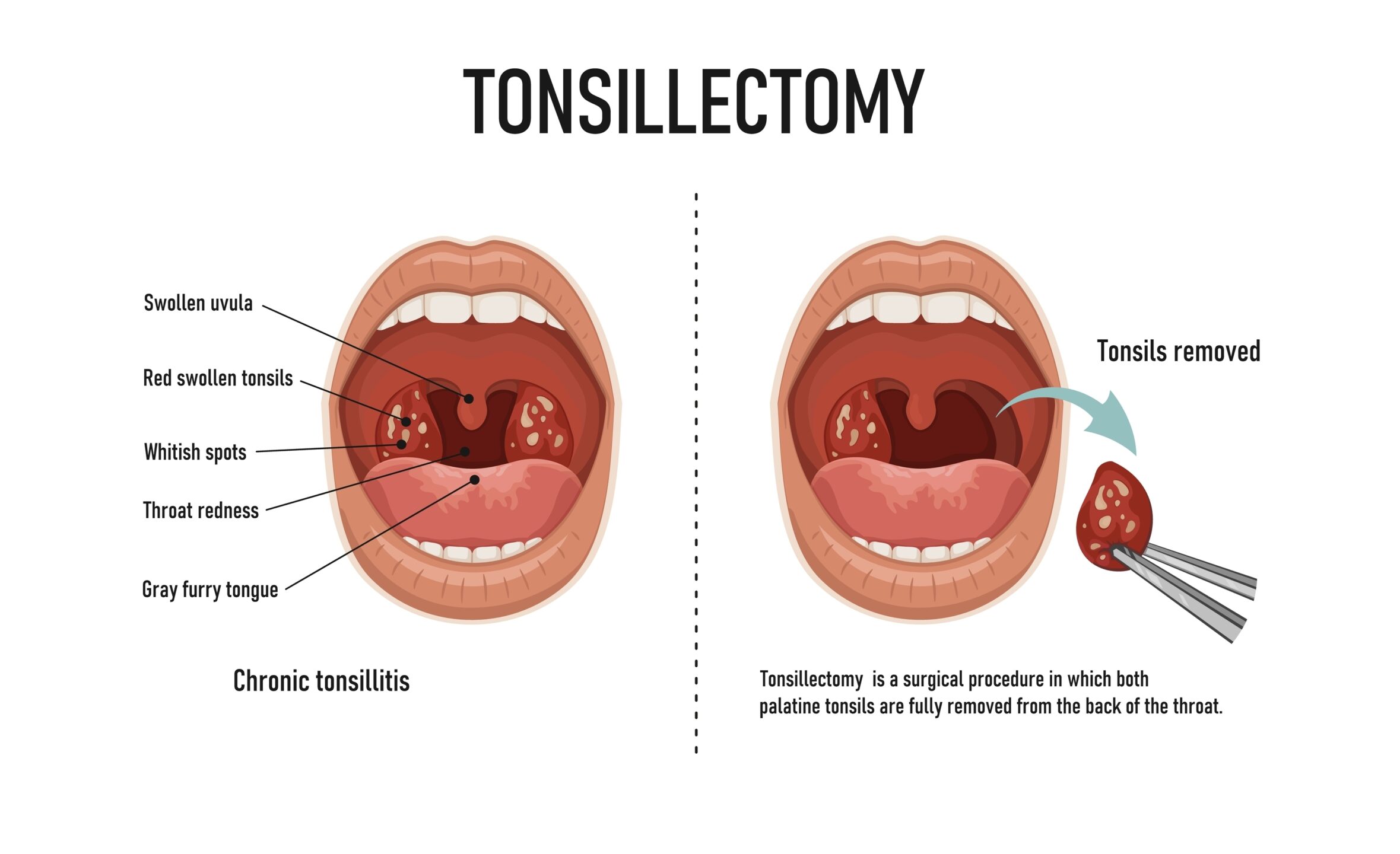 Why Are Tonsils Removed