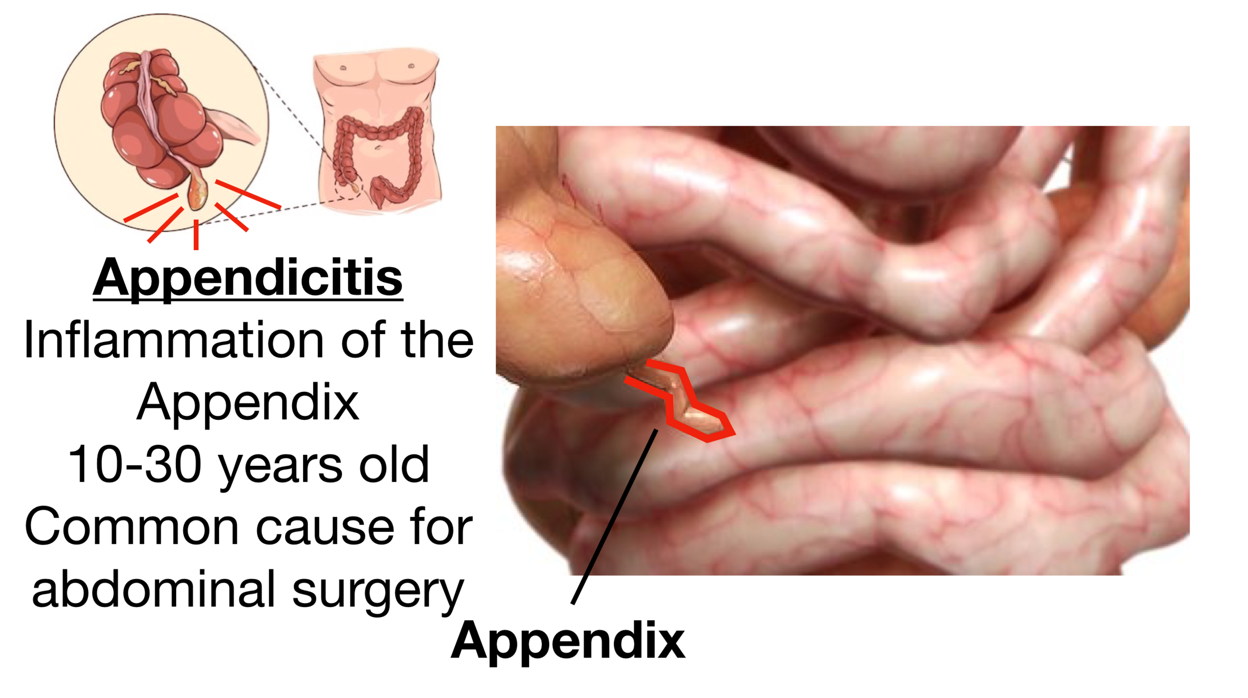 Why Do Appendix Burst