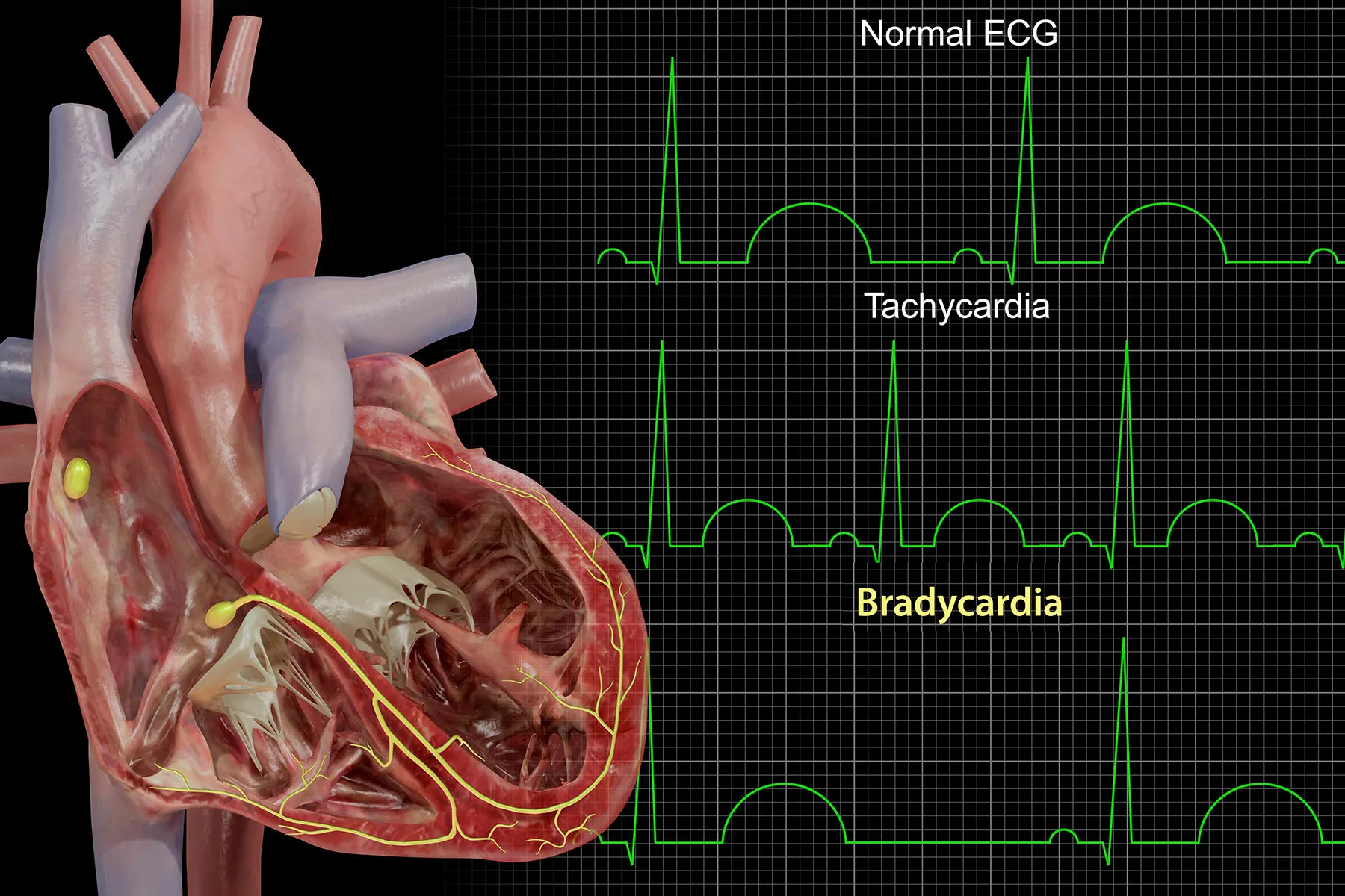 Why Is Bradycardia Dangerous