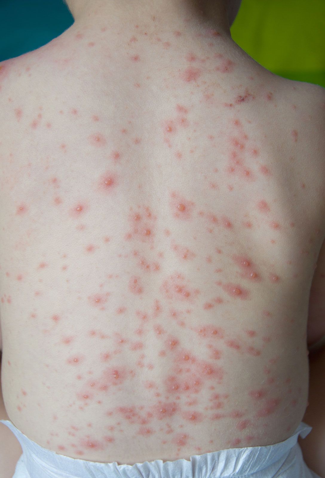 Why Is Called Chicken Pox