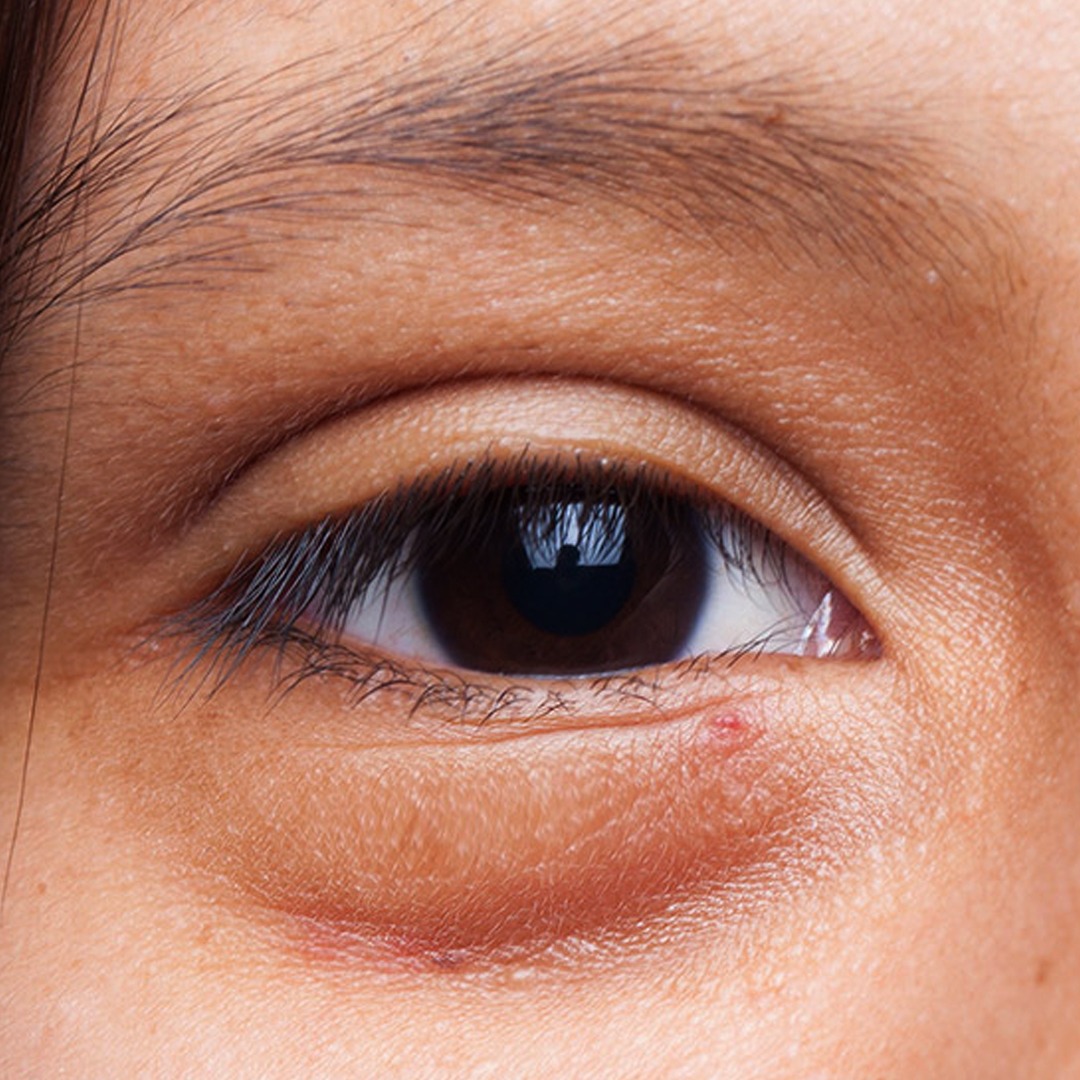 Why My Eyelids Are Puffy