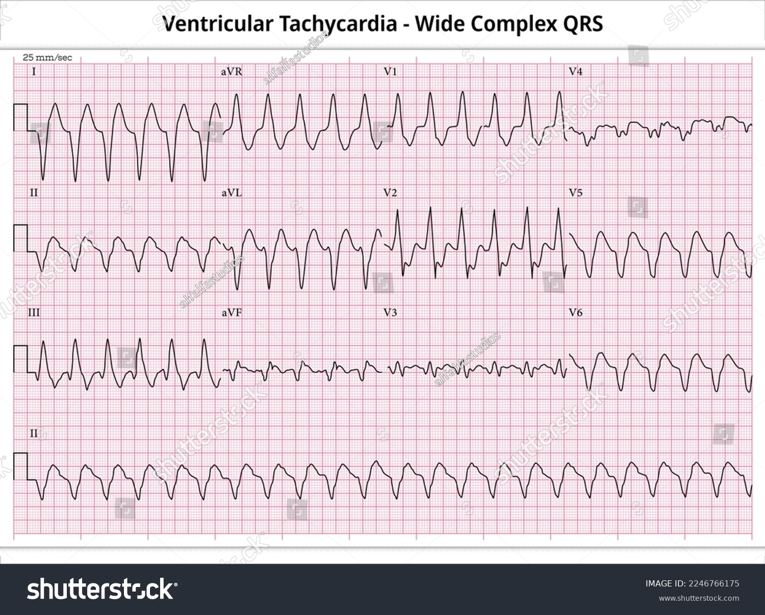 Widening Qrs Complexes