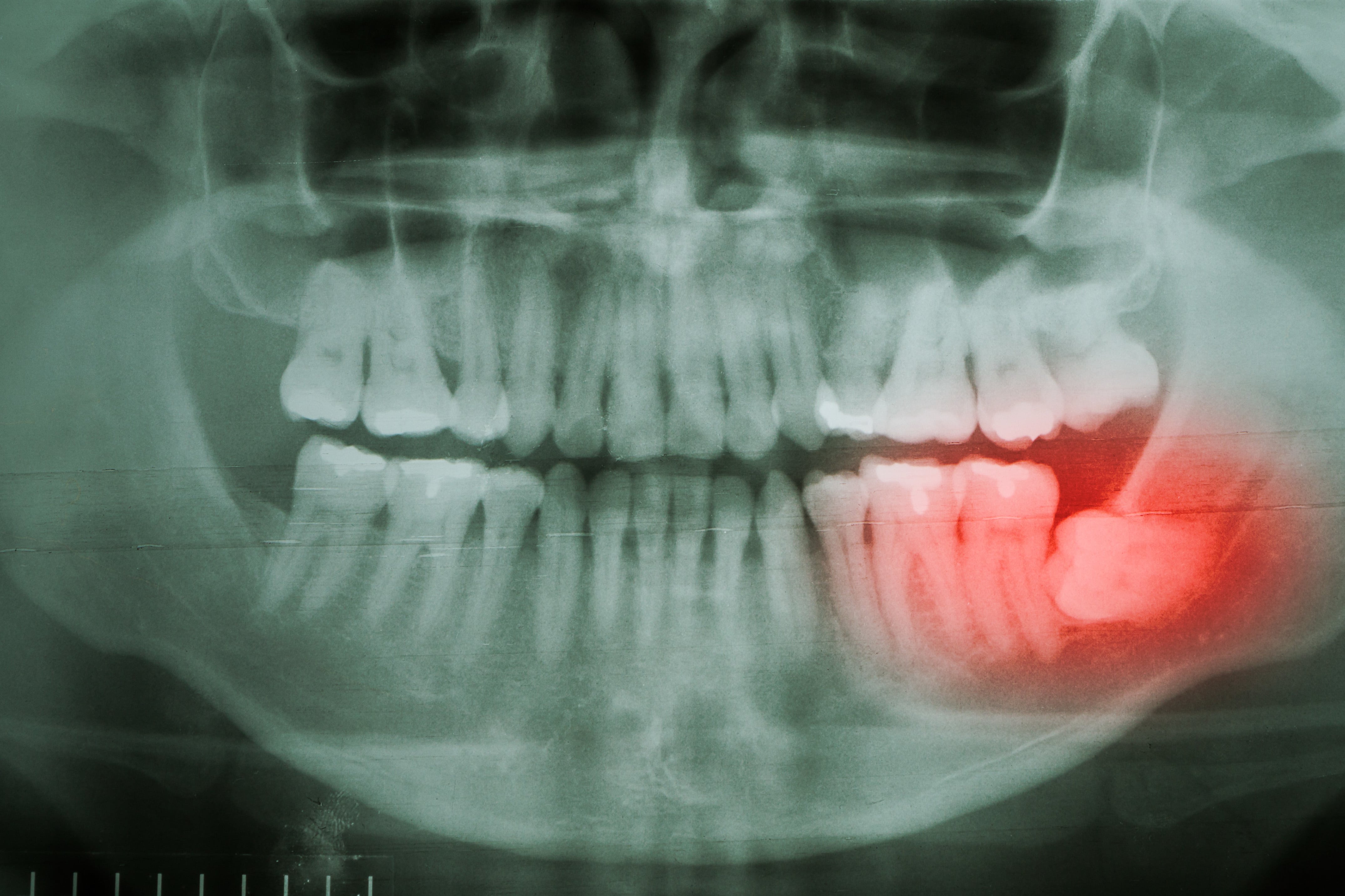 Wisdom Teeth Xray