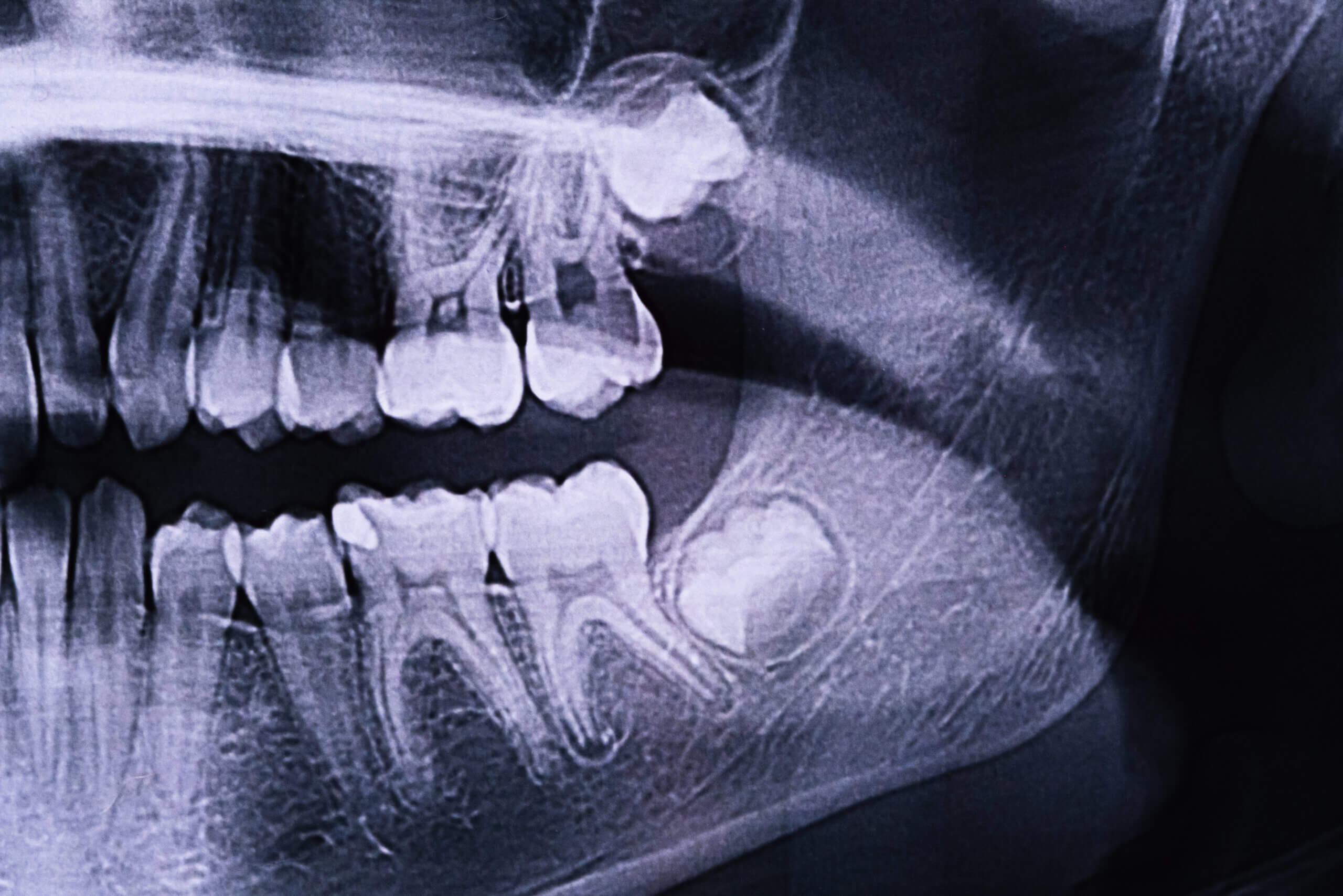 Wisdom Tooth Growing In