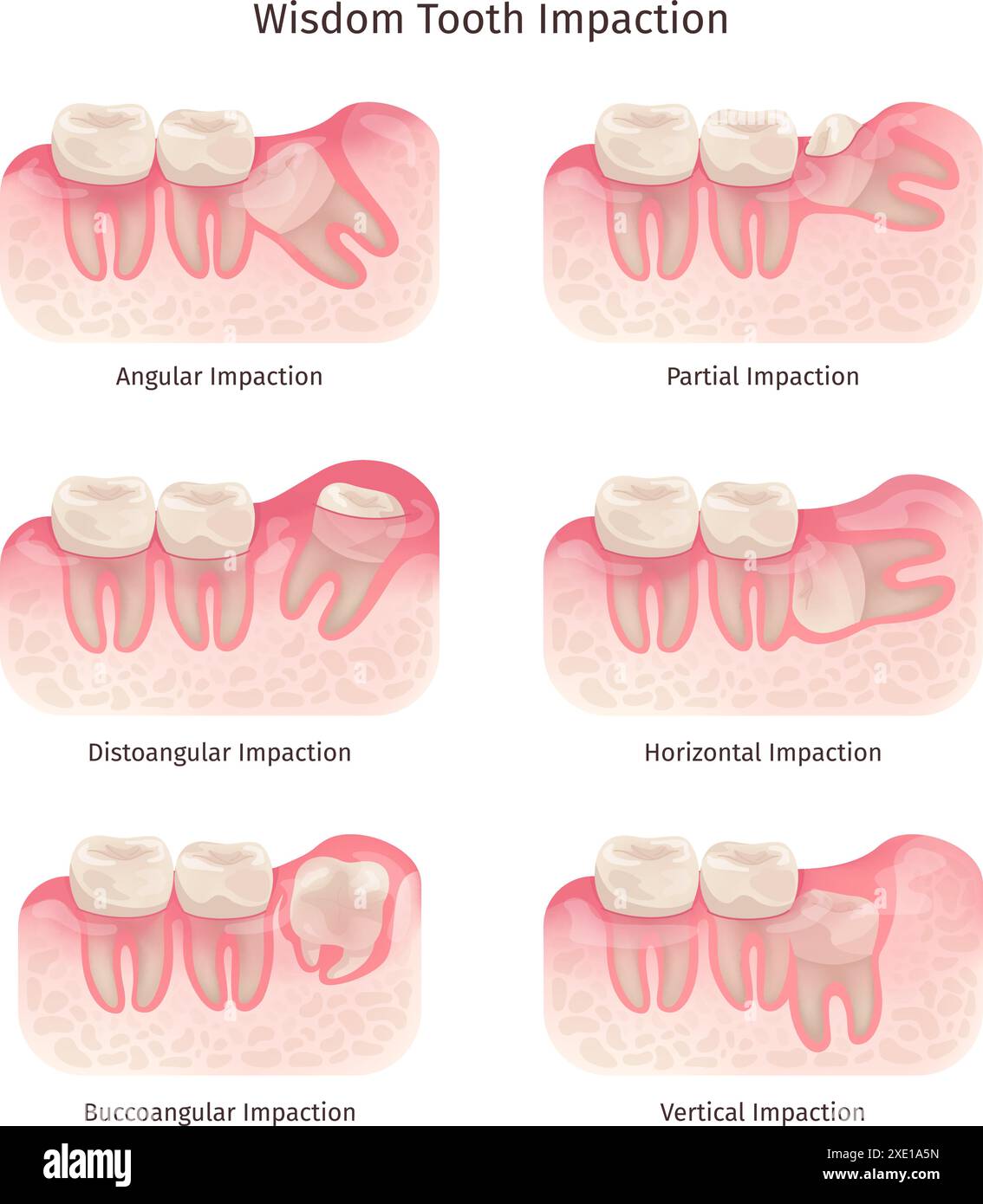Wisdom Tooth Gum Pain