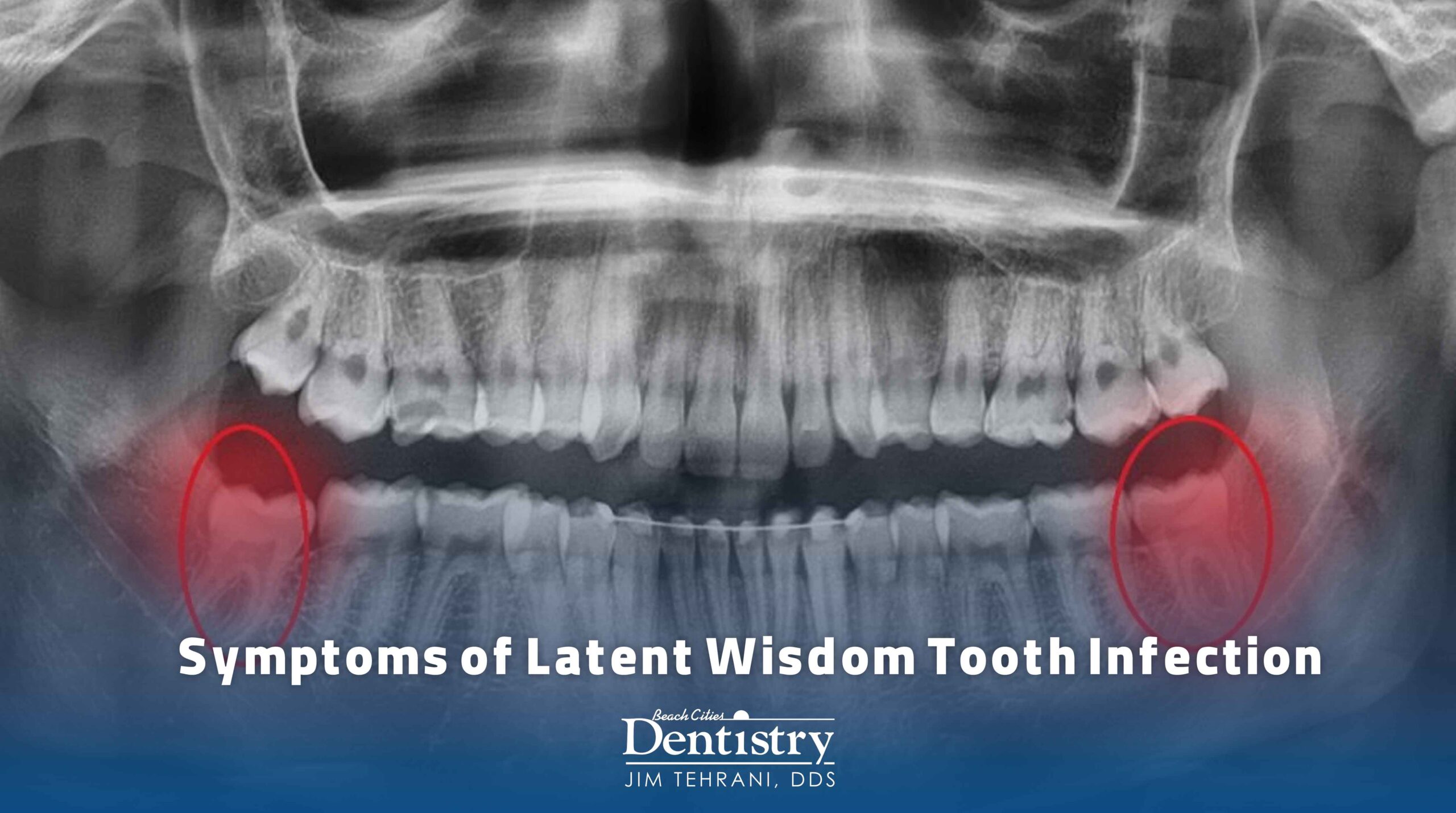 Wisdom Tooth Infection Symptoms