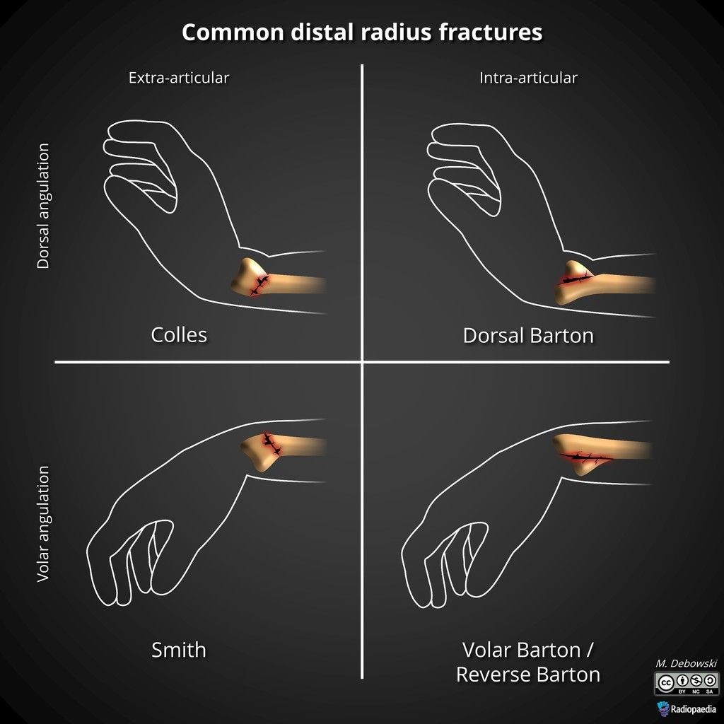 Wrist Fracture Types