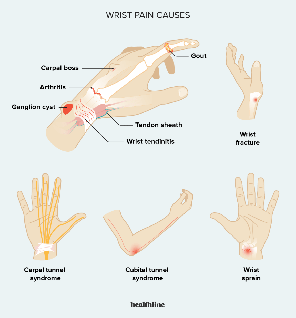Wrist Pain Pinky Side