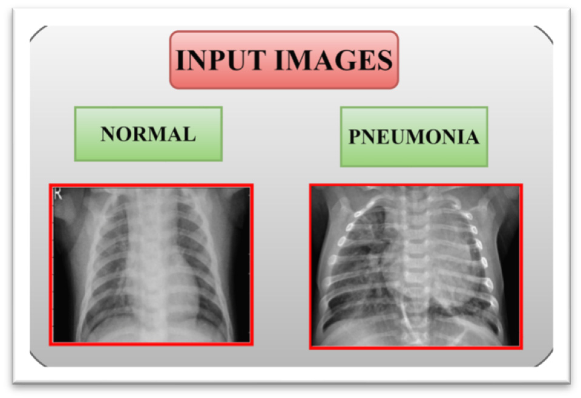 Xray In Pneumonia