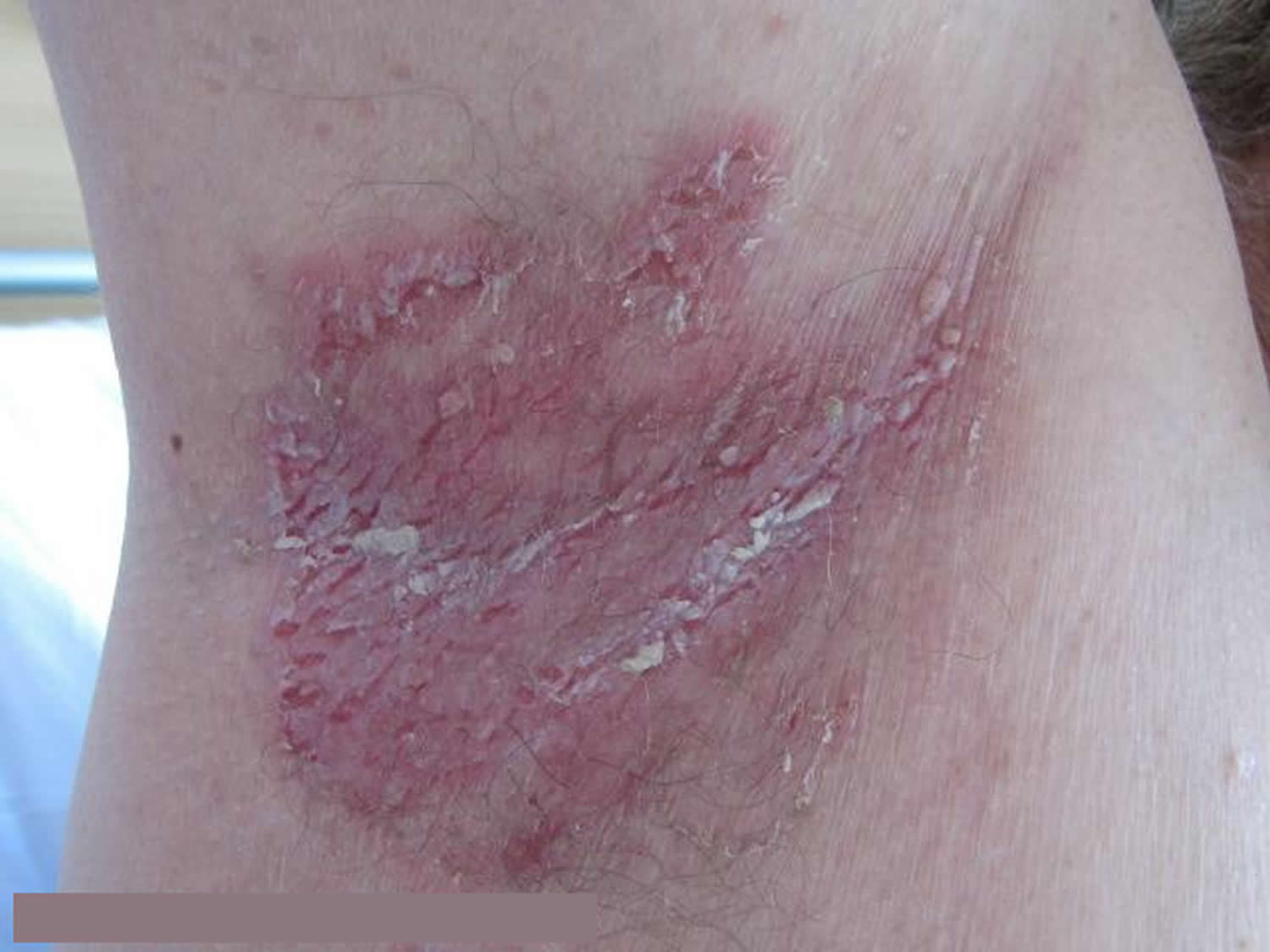 Yeast Infection In Armpit
