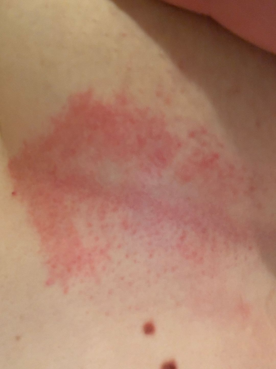 Yeast Under Breast