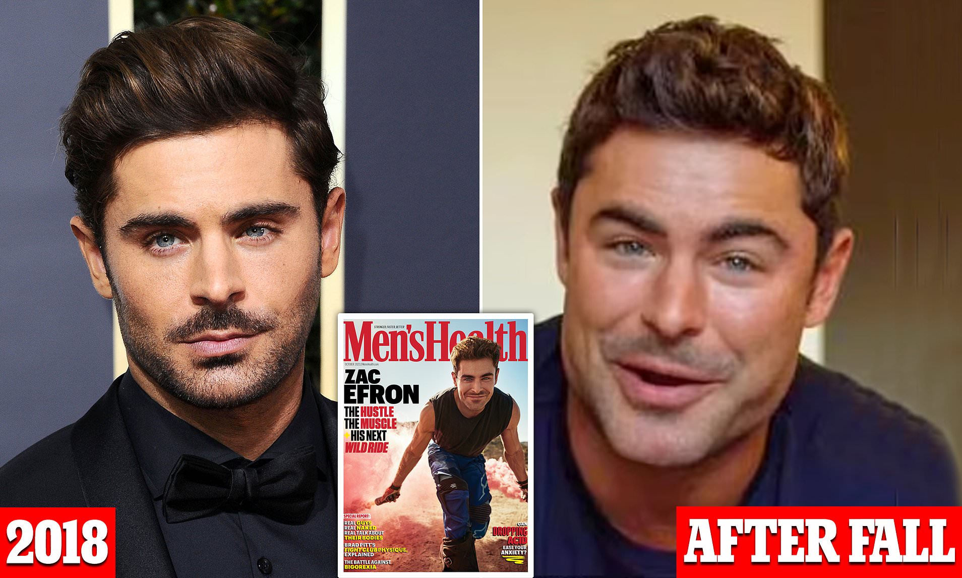 Zac Efron Face Plastic Surgery Video