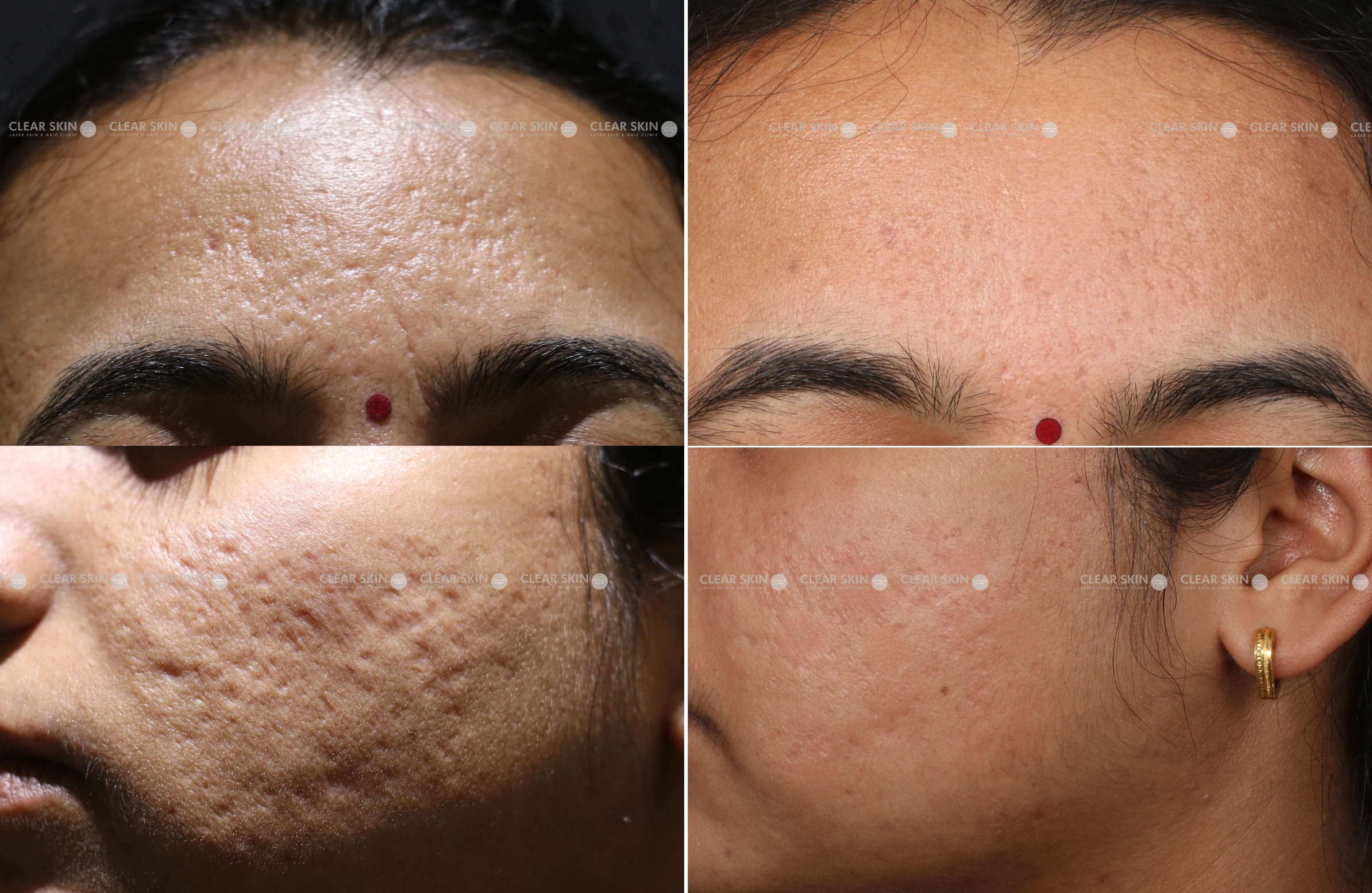 Zit Scar Removal