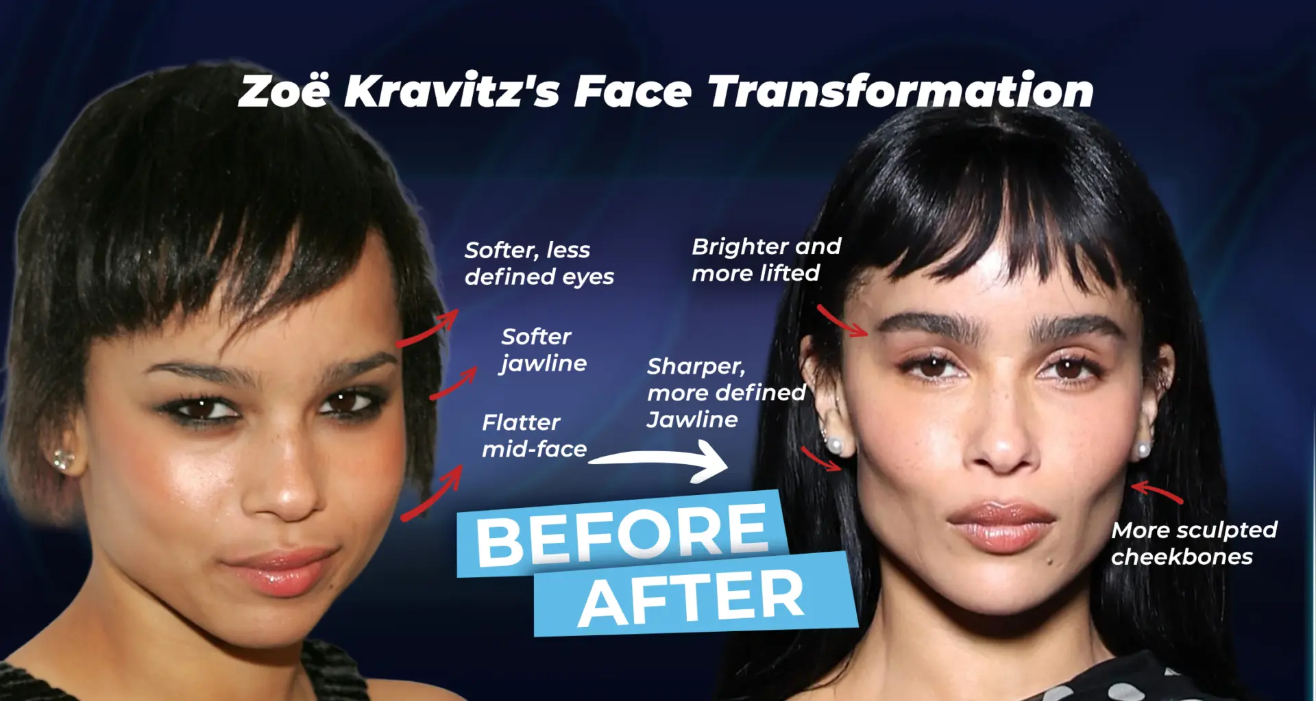 Zoe Kravitz Face Surgery